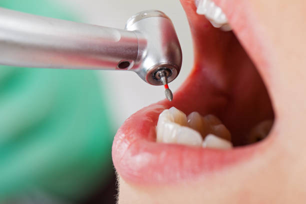 Best Emergency Treatment for Dental Infections or Abscesses in Van, TX